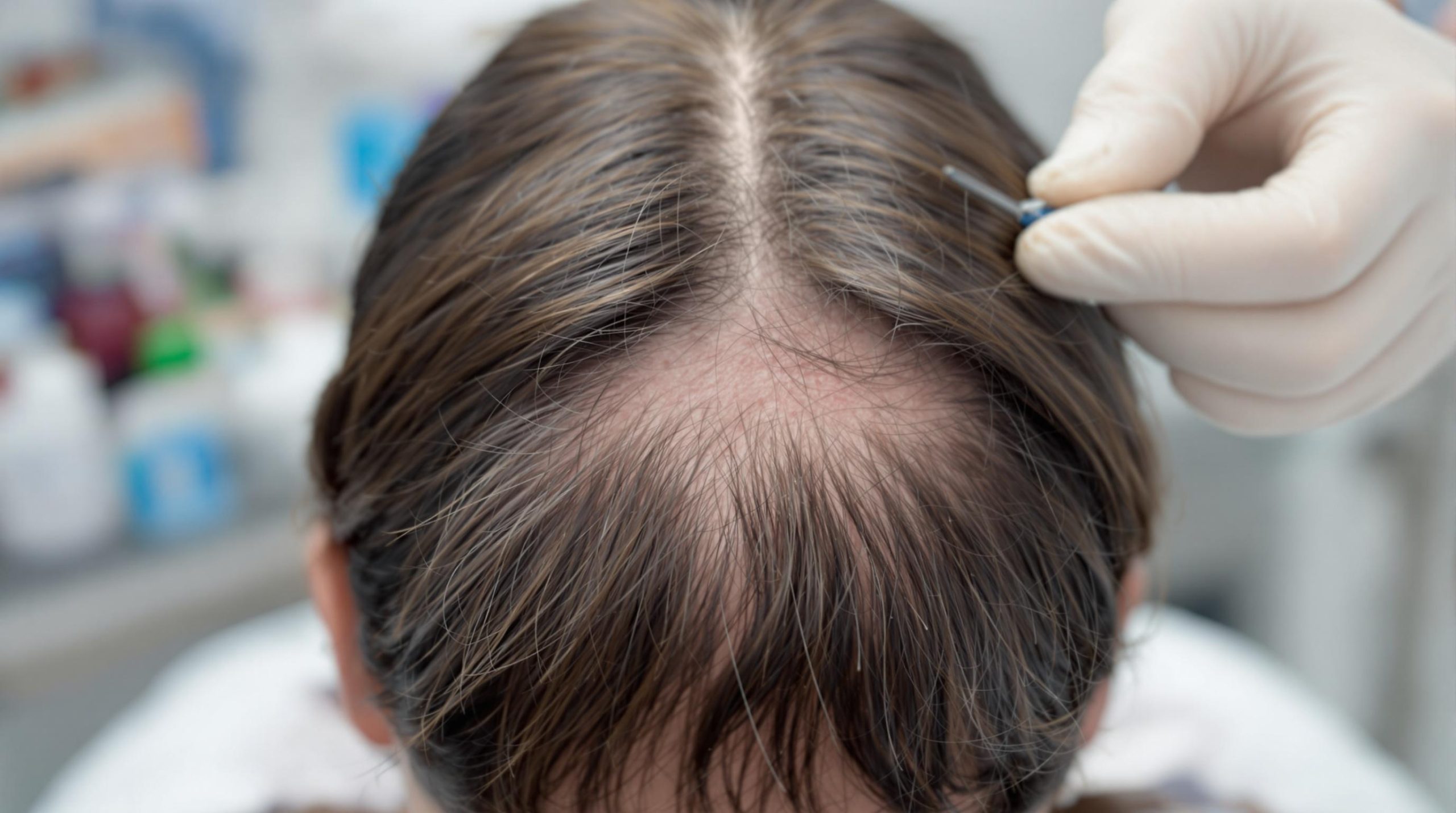Comprendre et soulager la douleur du cuir chevelu